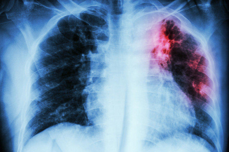 Diagnostic Techniques for Tuberculosis