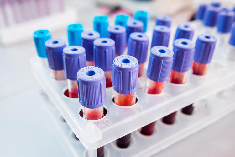 Biochemical blood test: transcript