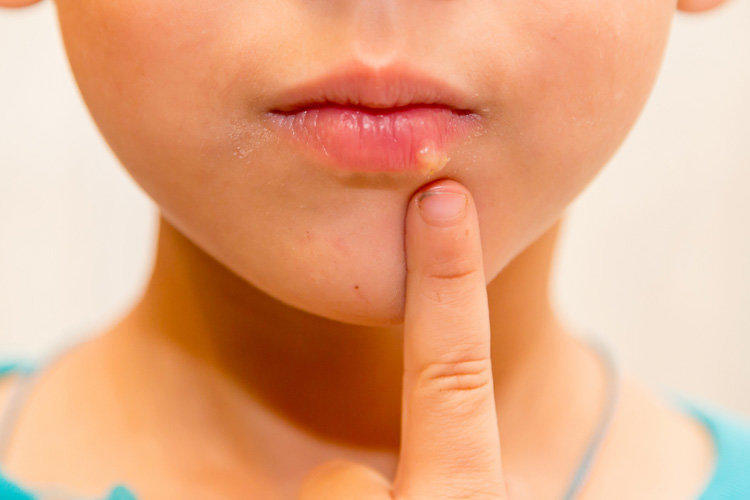 Stomatitis in children: causes and treatment