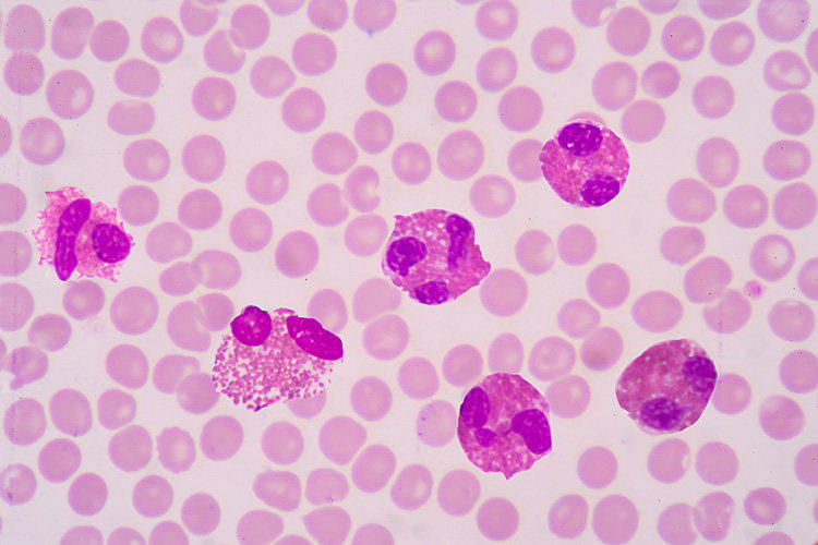 Elevated blood eosinophils in women and children: causes of abnormalities and normal